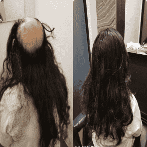 Avatar: Singapore hair transplant cost